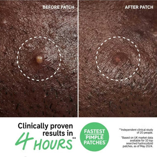 The Inkey List - Hydrocolloid Invisible Pimple Patches (22 Patches)